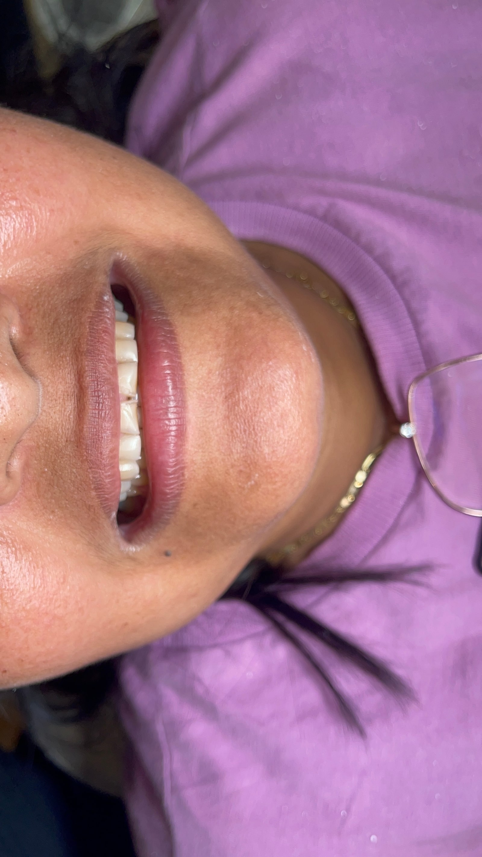 Antes — Facetas em porcelana — ajuste de forma e cor