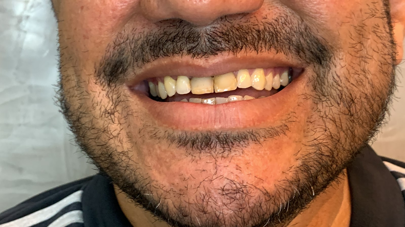 Antes — Facetas em porcelana — transformação do sorriso