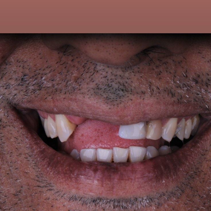 Antes — Facetas em porcelana — recuperação de dente fraturado